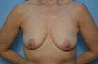 Breast Aug, lift and excision of accessory breast tissue