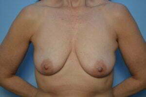 Breast Aug, lift and excision of accessory breast tissue