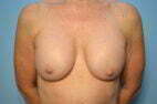 Breast Implant Removal and Total Capsulectomies
