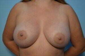 Breast Augmention