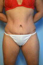 Standard Abdominoplasty