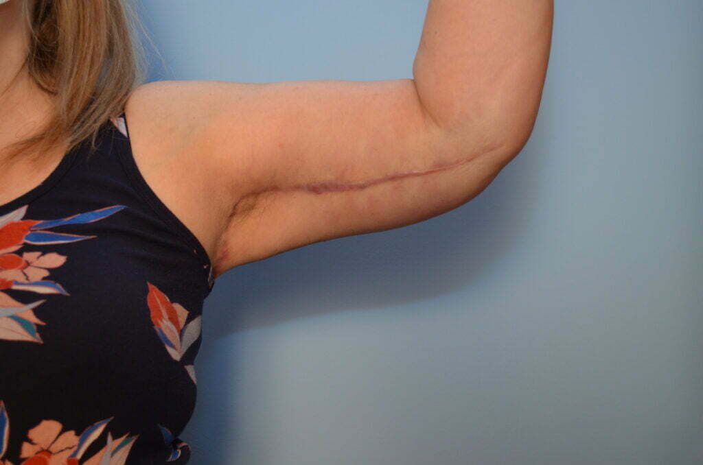 Ryder post op brachy 002