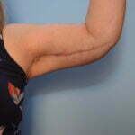 Ryder post op brachy 002