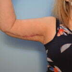 Ryder, post op brachy 003_01