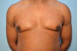Male Breast Reduction