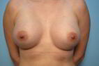 Breast Augmentation