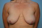 Breast Augmentation with Breast Lift, Removal Axillary Breast Tissue