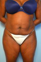 Abdominoplasty with Liposuction