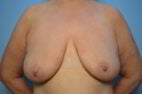 Breast Lift with Augmentation