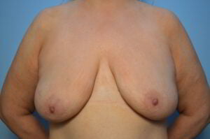 Breast Lift with Augmentation