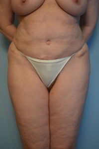 Tummy Tuck Liposuction