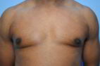 Male Breast Reduction