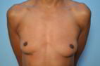 Breast Implant Removal