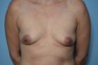 Breast Augmentation