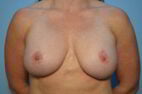 Breast Augmentation with Breast Lift, Removal Axillary Breast Tissue