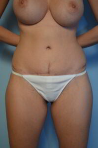 Abdominoplasty