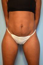 Abdominoplasty