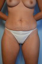 Abdominoplasty