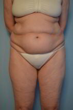 Tummy Tuck Liposuction