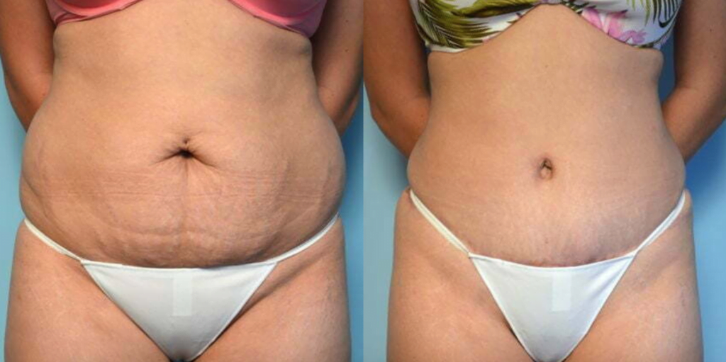 lipo-abdominoplasty specialist fairfax before and after